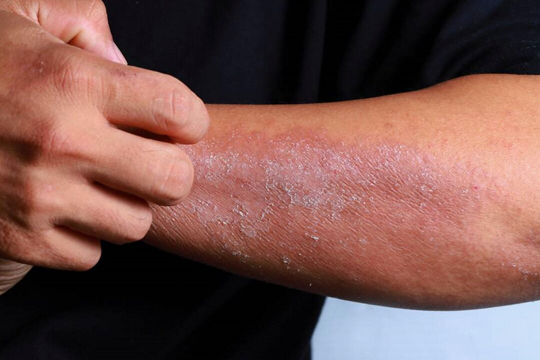 symptoms of psoriasis